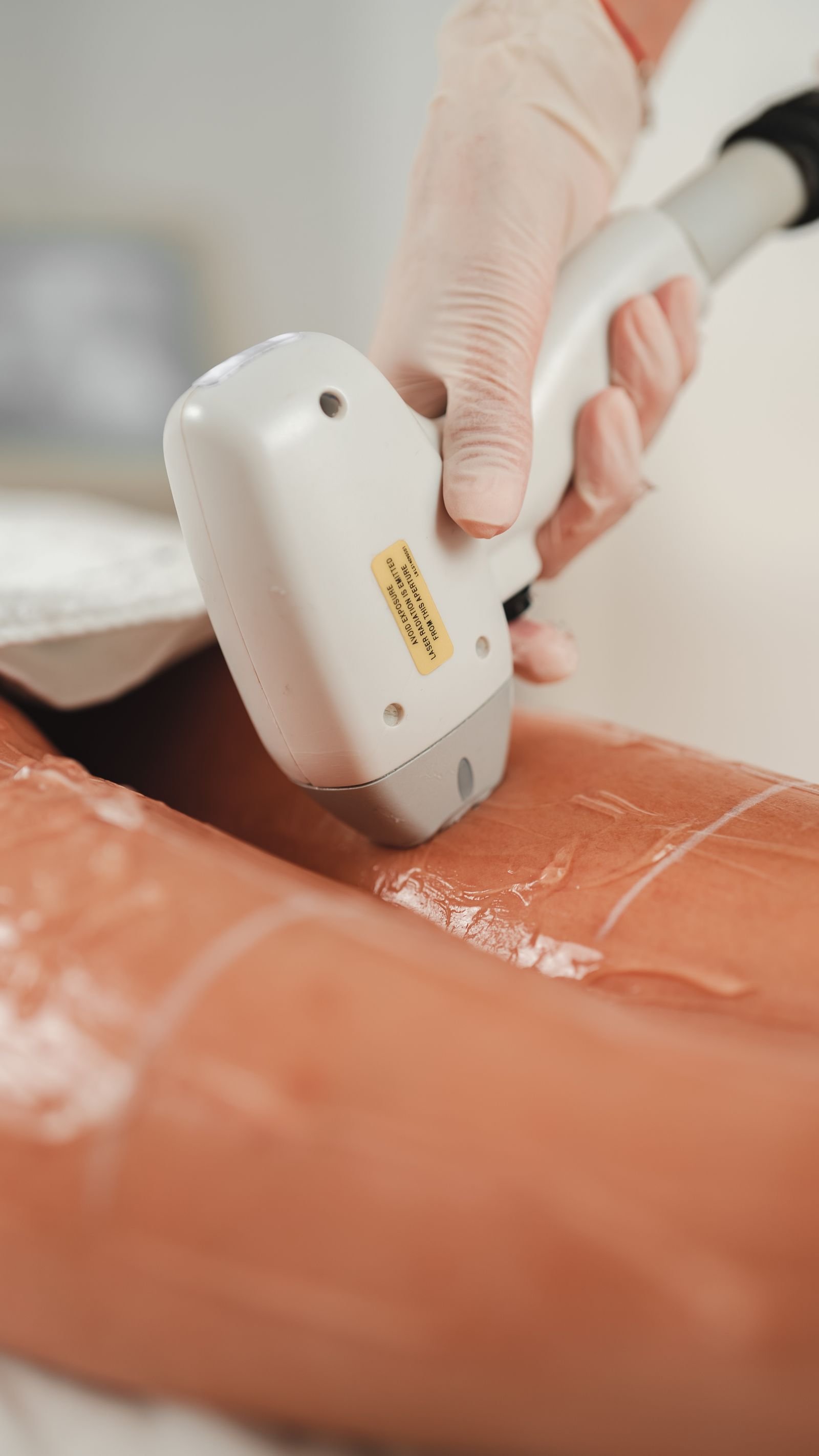 Laser hair removal — illustrative stock photo
